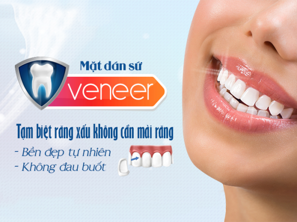 Mặt dán Sứ (Veneer sứ) – Phục hình thẩm mỹ bảo tồn răng thật