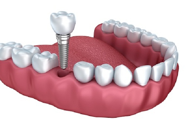 Cấy Ghép Implant